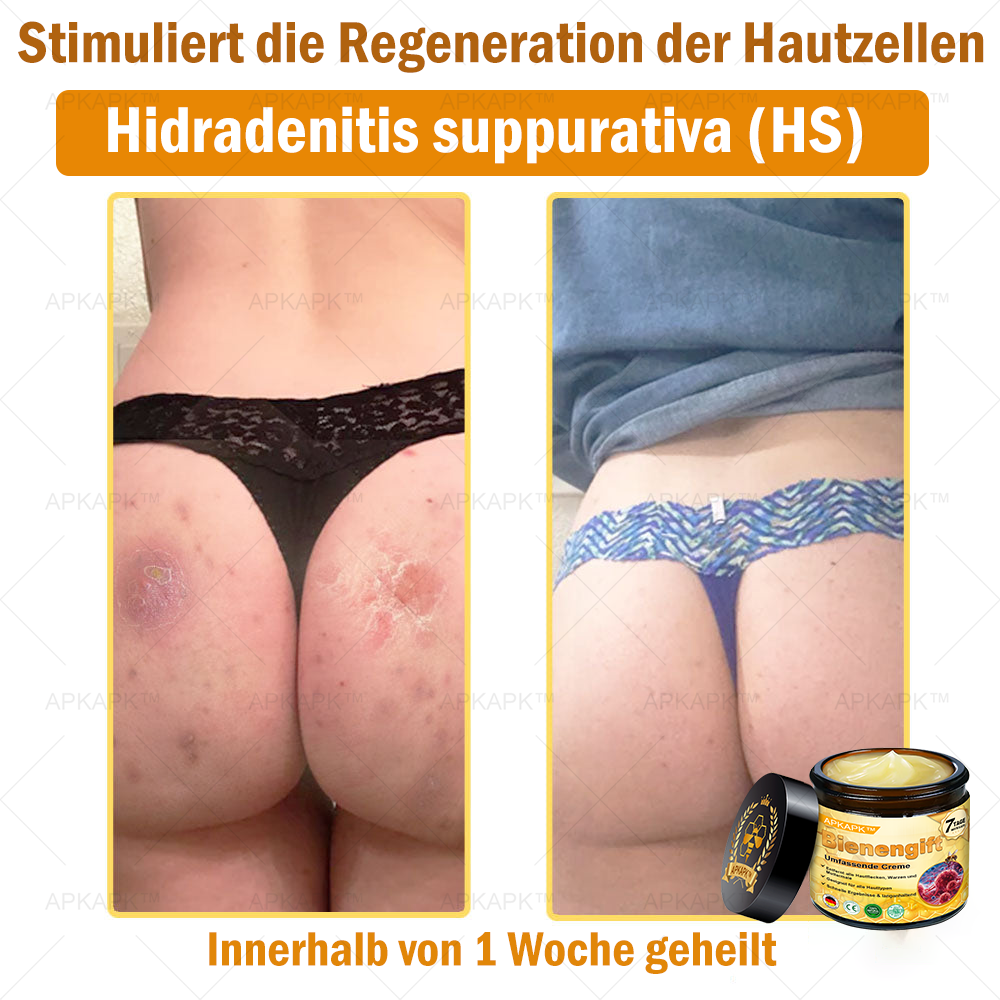 Hergestellt in Deutschland ✨✨AРKAРК™ Bienengift Umfassende Creme