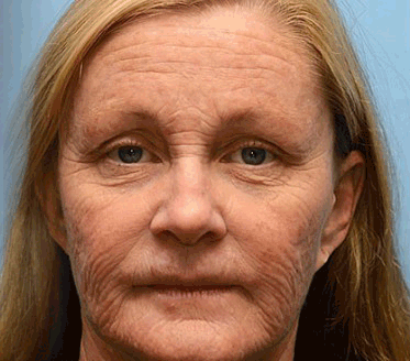 🐝🍀Hergestellt in Deutschland - ✨NEGUSY™ Botox Bienenvenom Faltenentfernungscreme